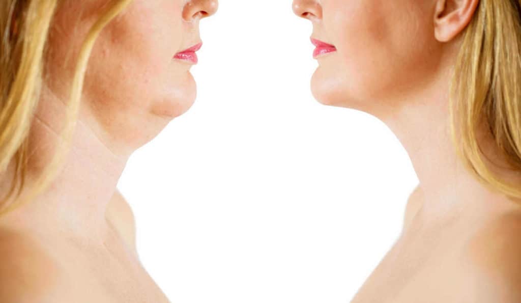 Double Chin treatment Staffordshire before and after results