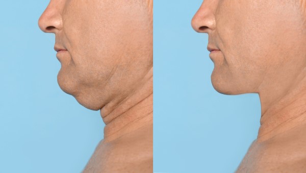 Which Non-Surgical Treatments Work Best for Jowls and Loose Skin Staffordshire?