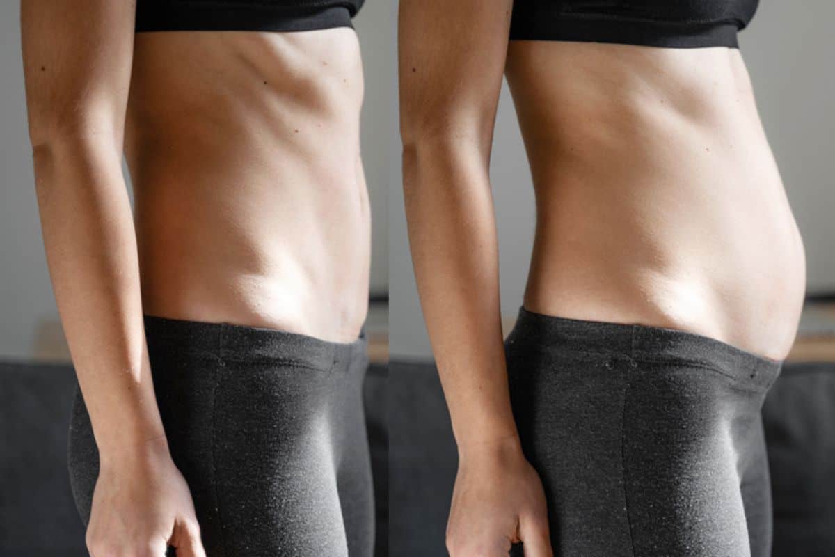 How long does diastasis recti take to improve Staffordshire?