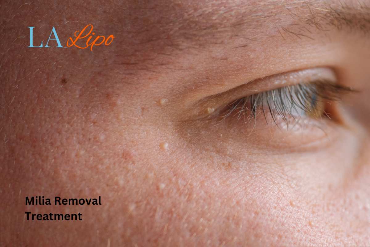 Cryopen Milia Removal: Is It the Easiest and Safest Option Staffordshire?