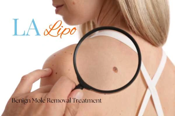 Woman having her inspection of blemish before mole removal Staffordshire