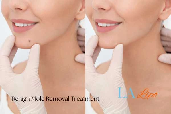woman's before and after mole removal Staffordshire results