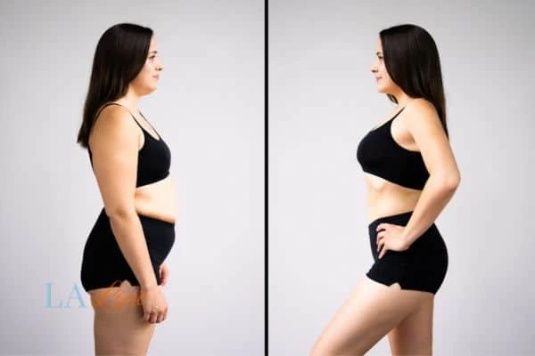 image of woman before and after results of LA-EMS Body Sculpting Staffordshire to help treat Diastasis recti