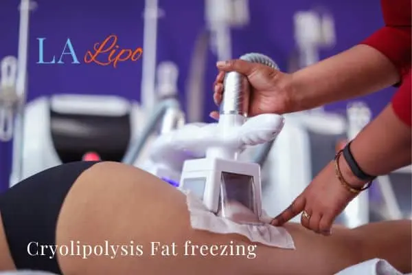 women getting fat freezing Staffordshire