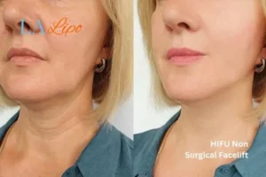 hi-fu for wrinkles Staffordshire before and after results