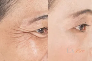 Before and after results of woman - HI-fu wrinkles reduction treatment Staffordshire