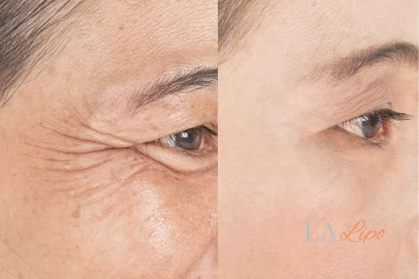 Before and after results of woman - HI-fu wrinkles reduction treatment Staffordshire