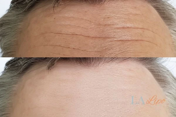 results of HIFU Staffordshire on mans forehead to help reduce lines and wrinkles