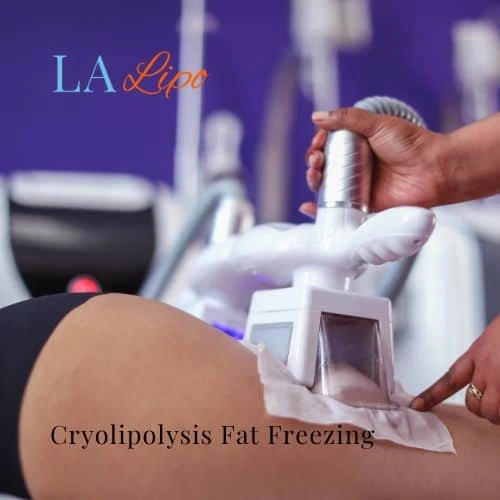 fat freezing - Cryolipolysis Staffordshire