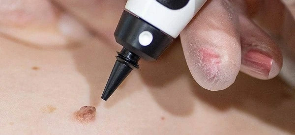 skin tag removal using cryopen Staffordshire