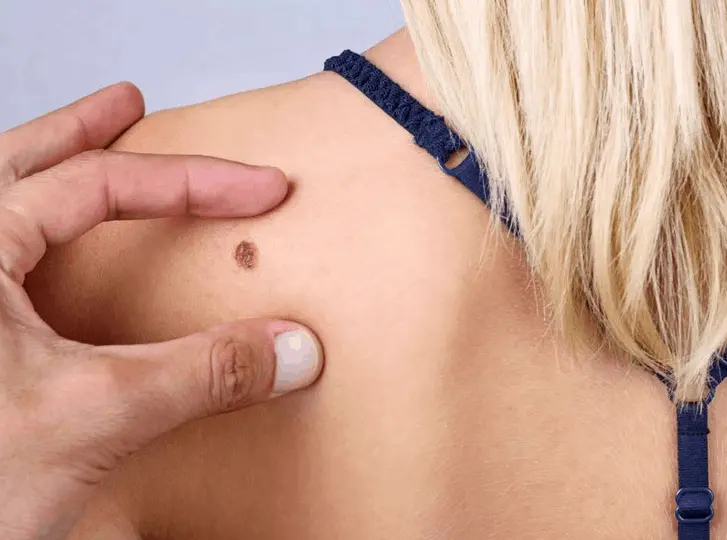 woman having mole removal Staffordshire consultation before treatment.