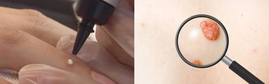 Person getting moles removed with cryopen Staffordshire