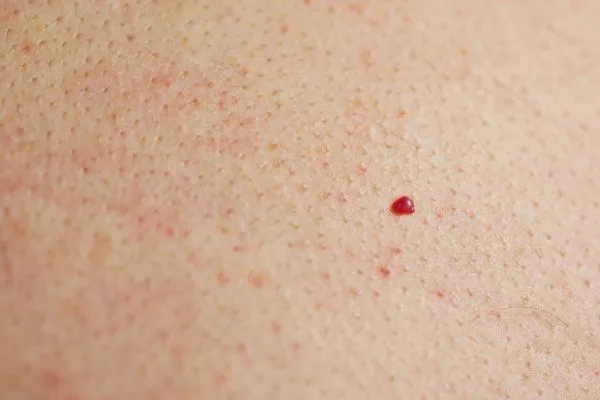 close up of a cherry angioma Staffordshire