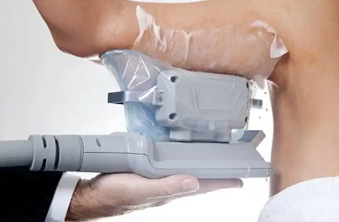 Picture of fat freezing Staffordshire on the upper arms.