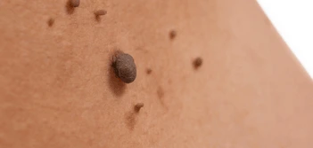 image of a skin tag Staffordshire