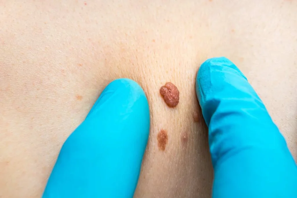 Consultant examining a skin tag Staffordshire