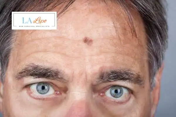 Solar Lentigo Removal Staffordshire image of man with mark on his forehead