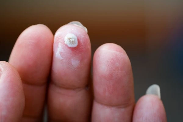wart on person finger - cryotherapy to treat from LA LIPO Staffordshire