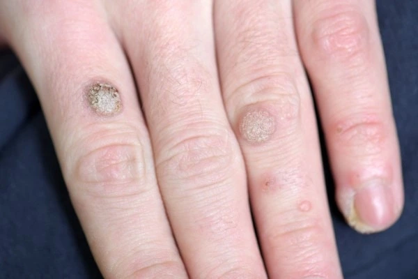 photo of warts on person hand - see wart removal Staffordshire from LA LIPO