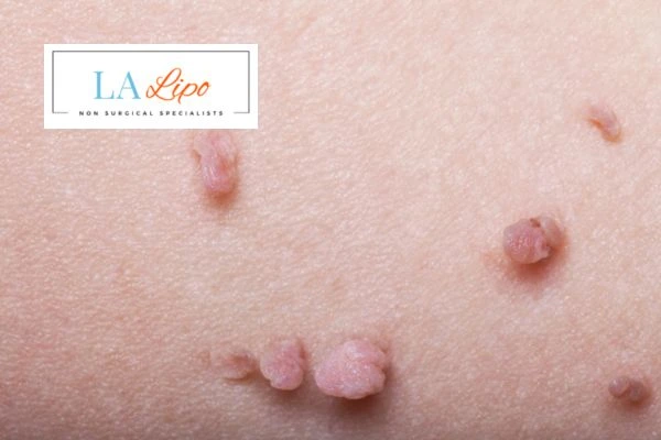 Does cryopen skin tag removal Staffordshire hurt? Find out now call our team today!