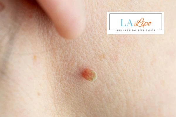 Book skin tag removal Staffordshire today speak to our team now!