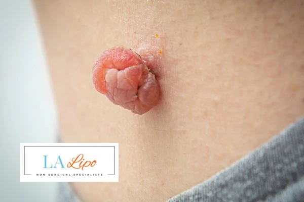 Interested in skin tag removal Staffordshire? Concerned about the pain? Find out more today!