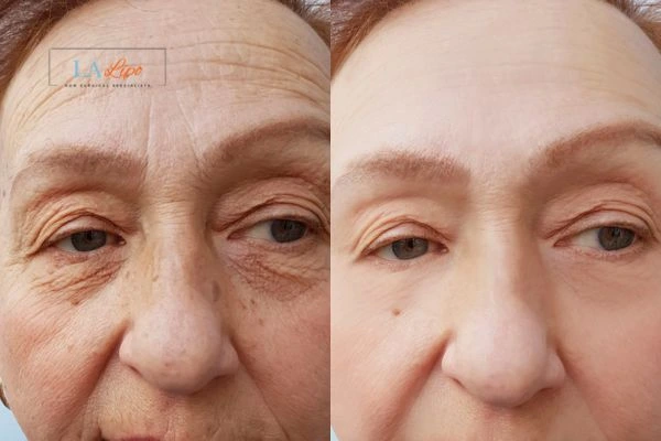 The powerful benefits of Morpheus8 Treatment Staffordshire - Call Our team today!