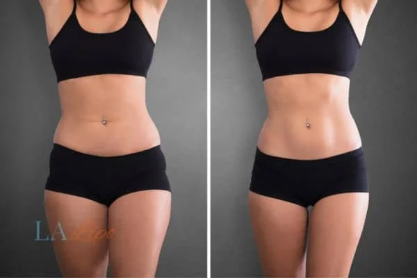 before and after results of non-surgical treatment to help a woman's body image and mental health Staffordshire