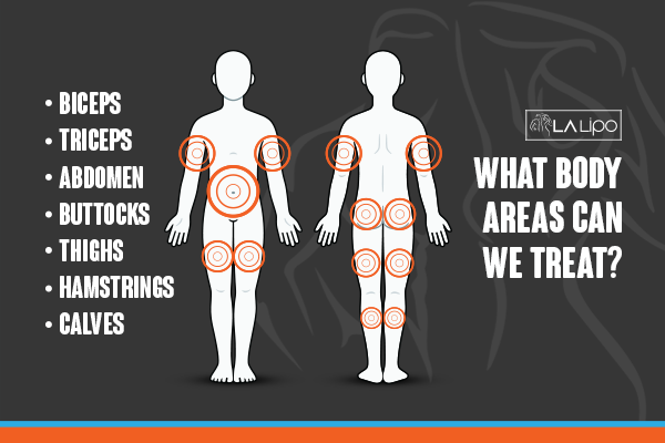 Diagram to show areas you can have LA-EMS Body Sculpting Treatment Staffordshire
