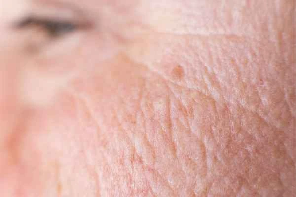 close up picture of a woman's face showing an age spot Staffordshire