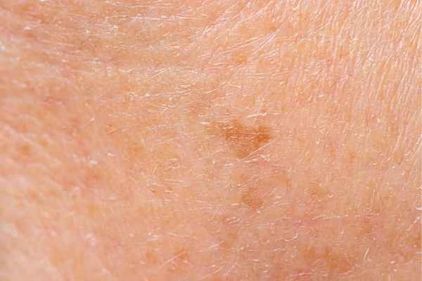close up picture of age spots Staffordshire
