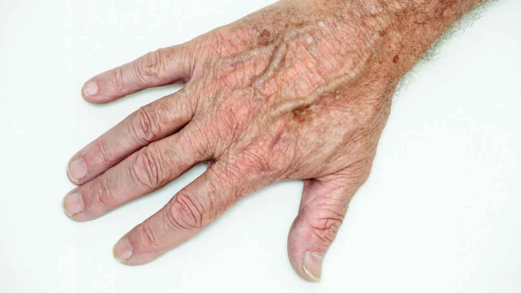 Male hand showing age spot Staffordshire