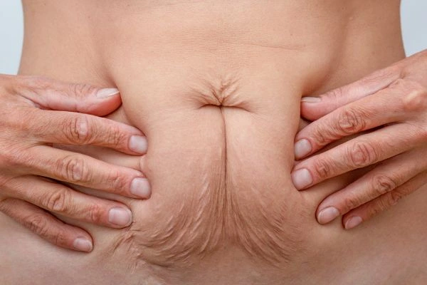 Image of a woman's stomach with loose skin - example of skin tightening Staffordshire options