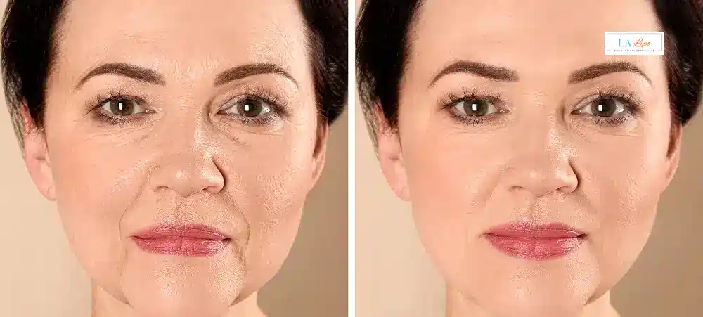 How Long Does It Take to See Results and How Long Do They Last Staffordshire?