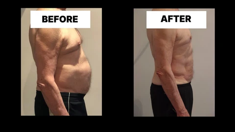 What Symptoms Can Diastasis Recti Cause in Men? Weak Core, Back Pain and Poor Posture Staffordshire